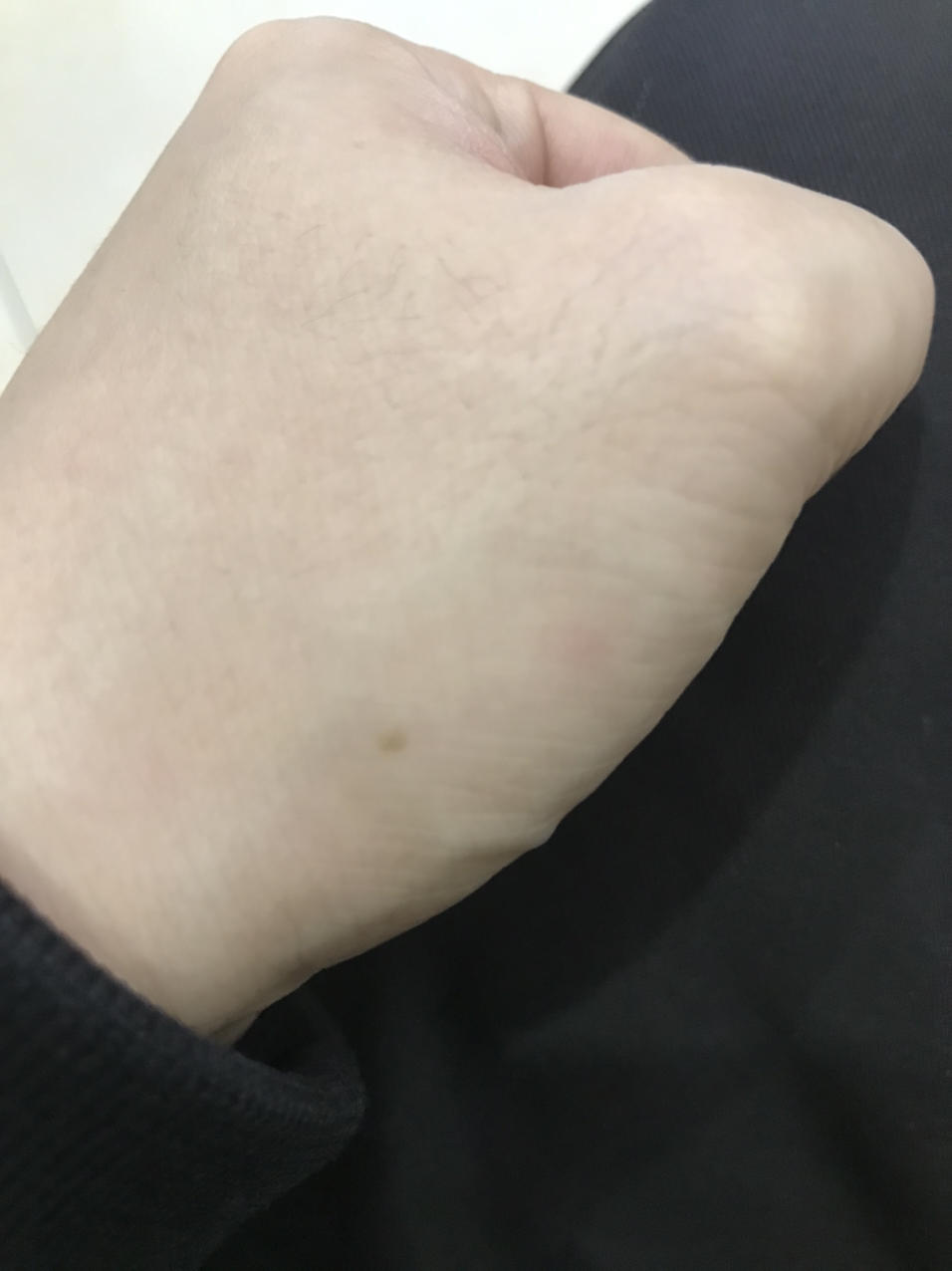 老哥们,我左手大拇指从小就有个红点,是什么病?